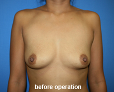 plastic-surgery-breast-augmentation